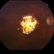 Retinoblastoma - Regressed Retinoblastoma - Regressed